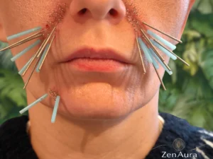 Kosmetyczna akupunktura – nakłuwanie bruzdy nosowo-wargowej cienkimi igłami w gabinecie ZenAura