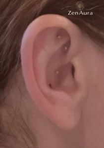 Aurikuloterapia akupunktura ucha – igły permanentne na łagodzenie problemów trawiennych w ZenAura