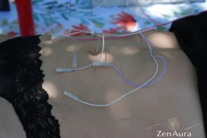 Elektroakupunktura na endometriozę – igły na brzuchu pacjentki w plenerze z aparaturą ZenAura