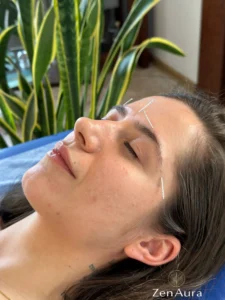 Terapia migreny igłami – pacjentka z igłami na twarzy w gabinecie ZenAura